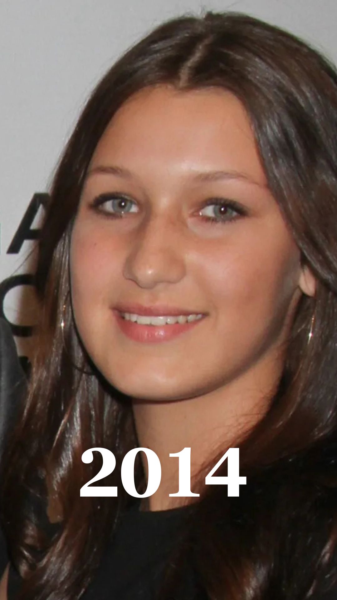 Bella Hadid plastic surgery after
