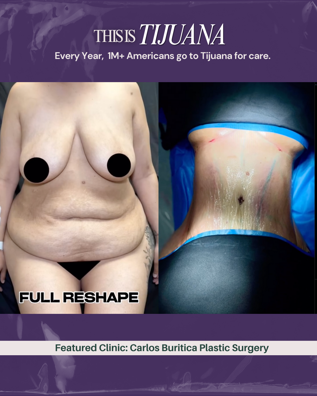 Buritica-Plastic-Surgery-tijuana
