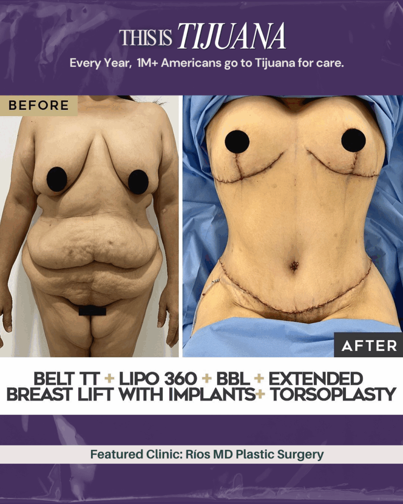 Dr. Andrei Rios Tijuana before after
