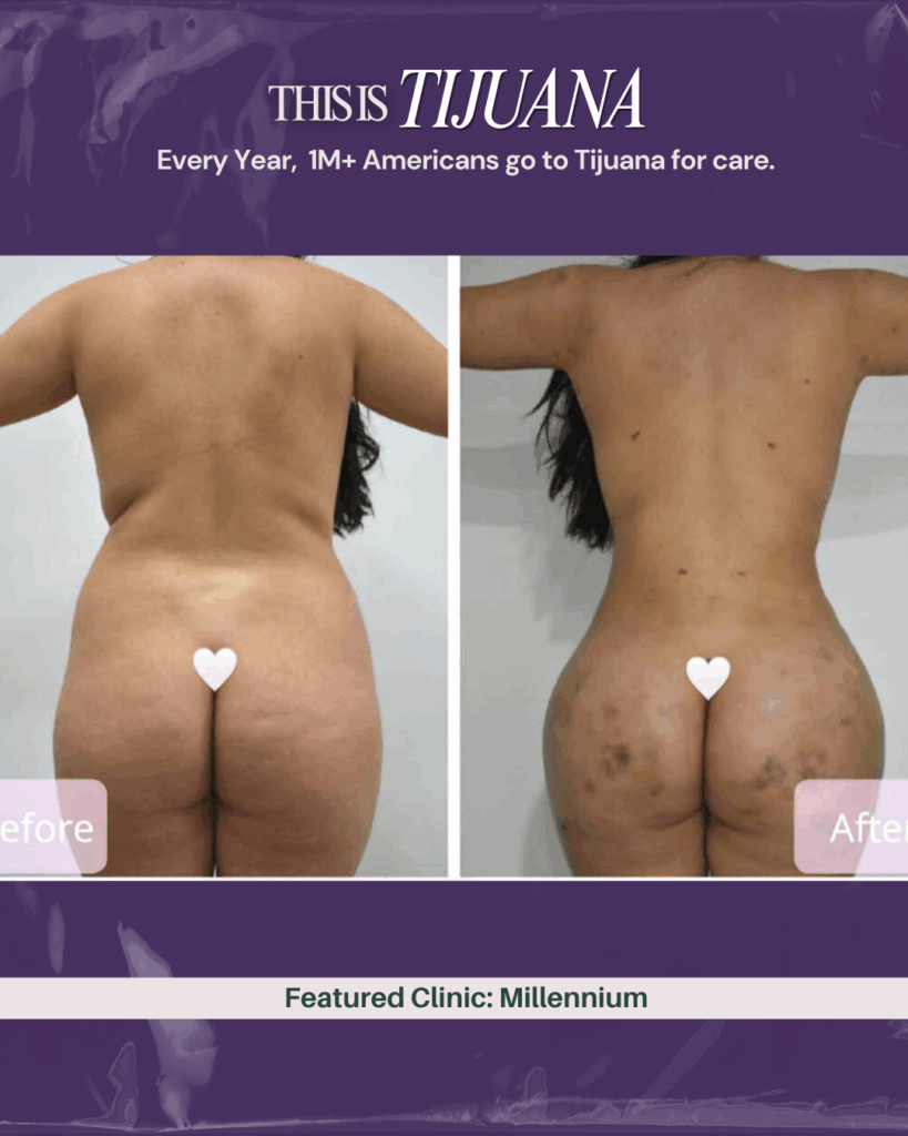 Millennium Clinic Tijuana plastic surgery