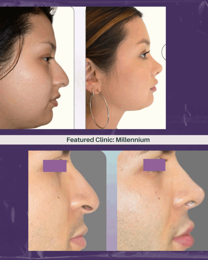 Before and after Millennium Clinic Tijuana