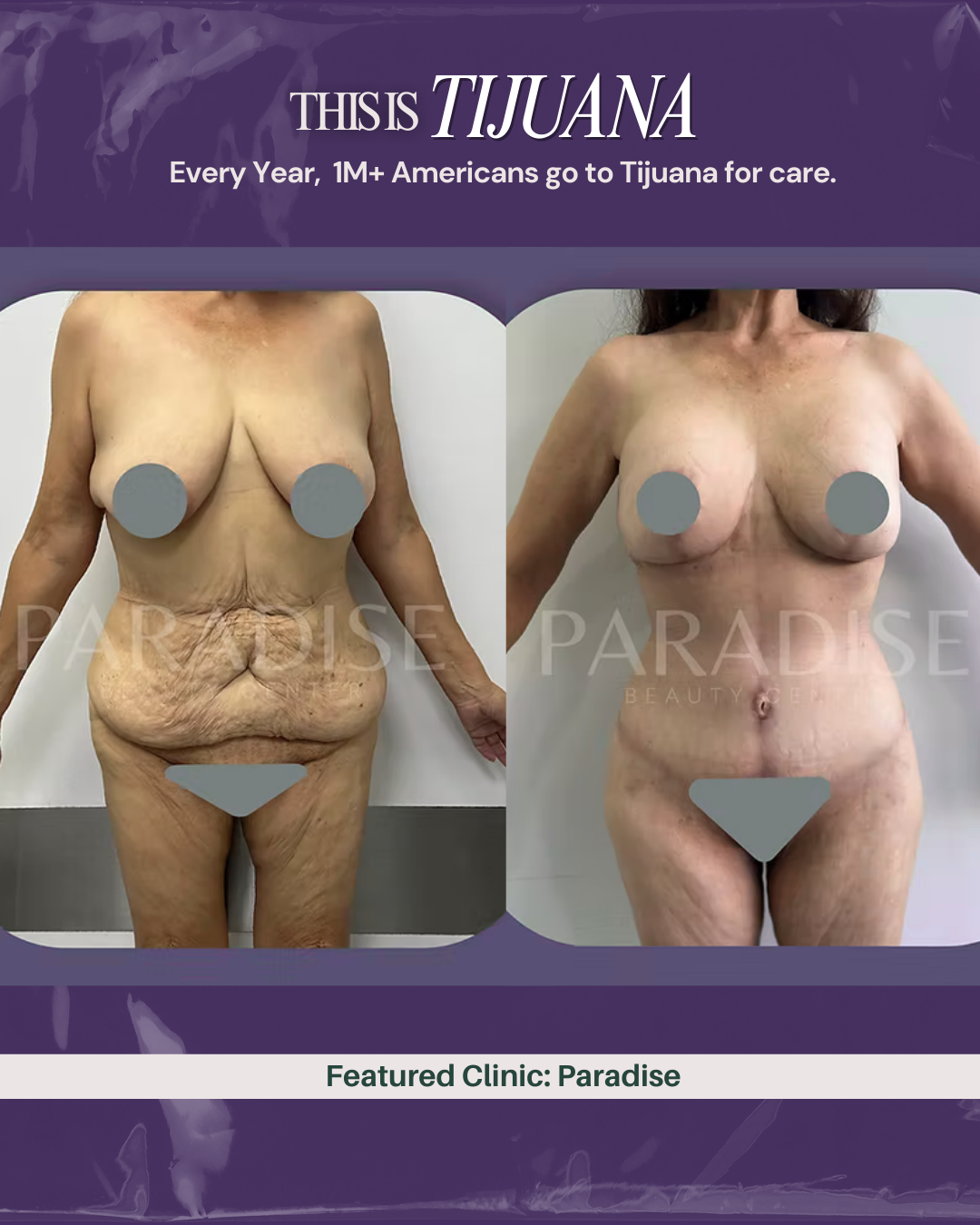 Paradise-Beauty-Center-tijuana-plasticsurgery