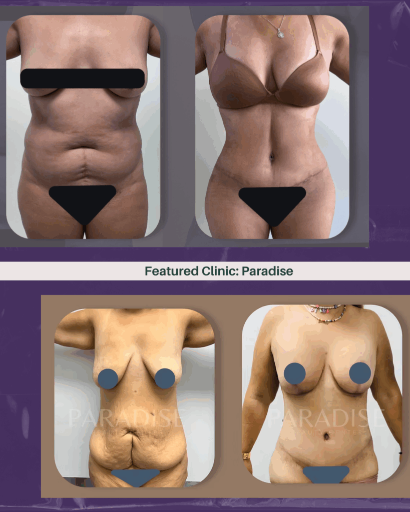 Paradise Beauty Center Tijuana body contouring
