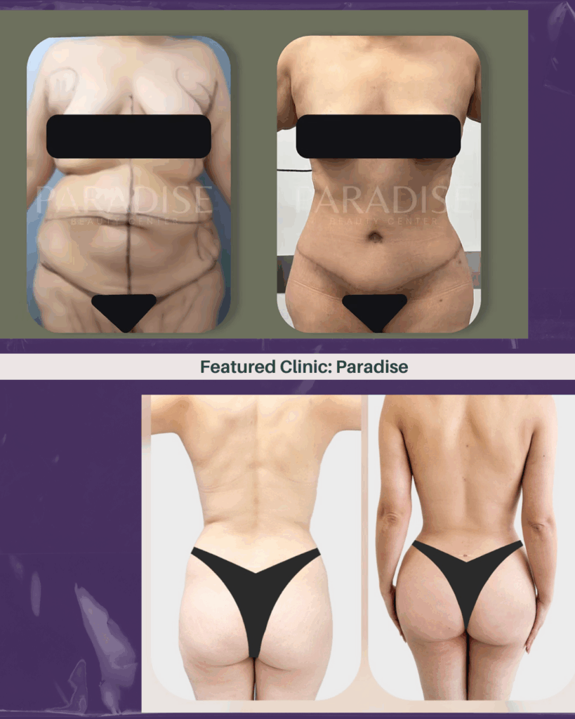 Paradise Beauty Center Tijuana body contouring
