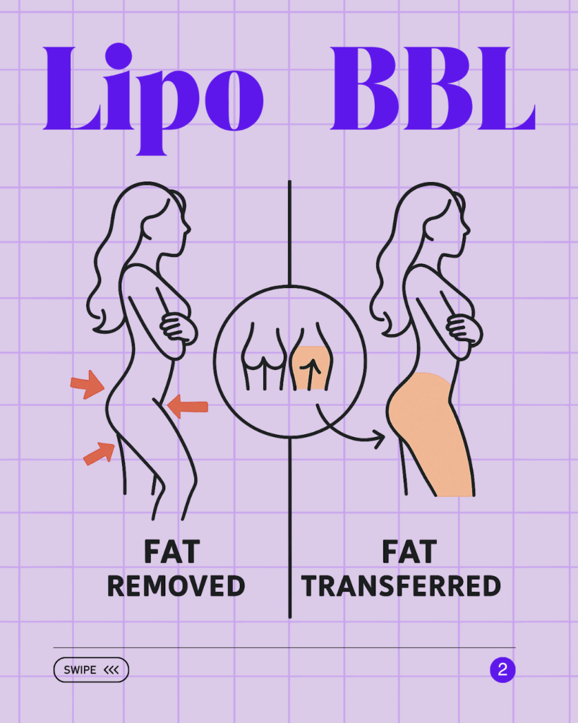Lipo vs BBL Tijuana