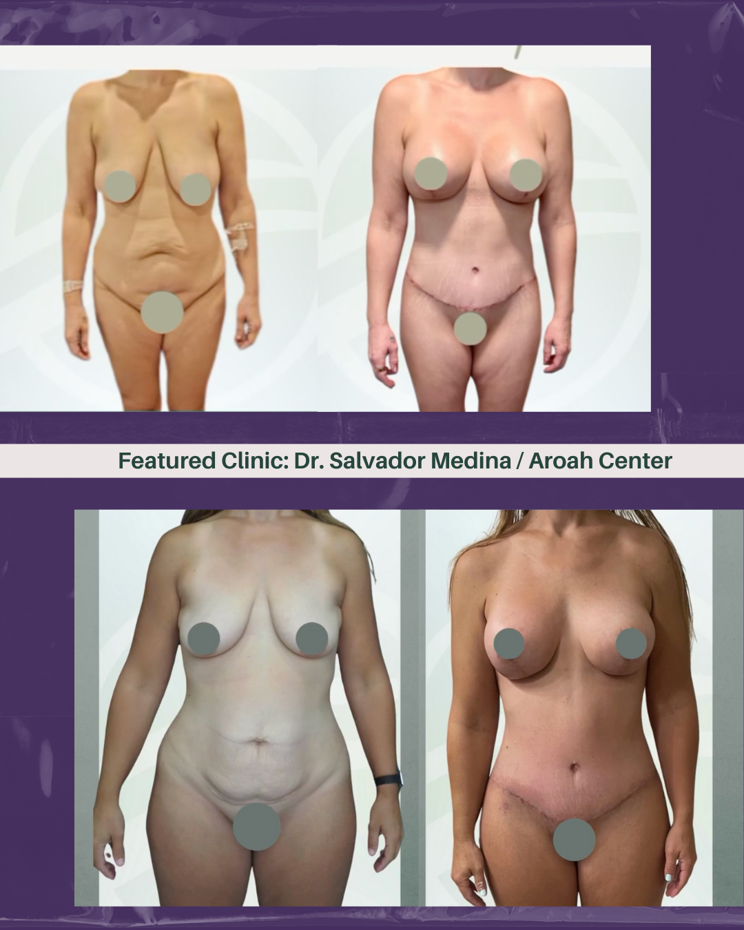 Dr. Salvador Medina Tijuana plastic surgery is trusted by post-bariatric patients looking for safe, affordable, high-quality results near the U.S.–Mexico border.